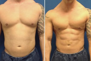 abdominal-etching abdominal-etching