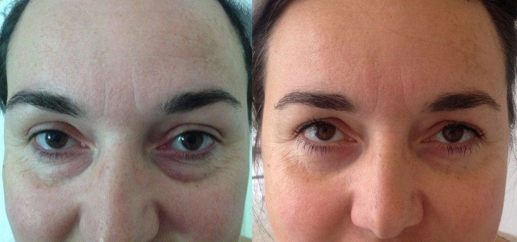Résultat de la blépharoplastie au Maroc