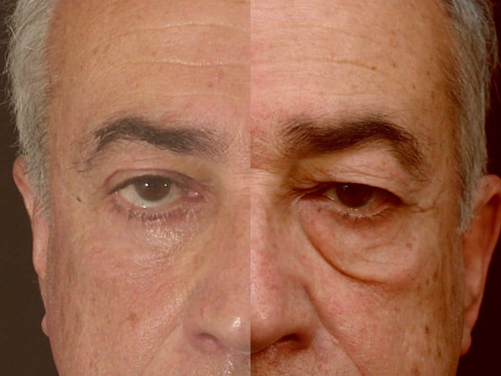 Blepharoplastie à Marrakech