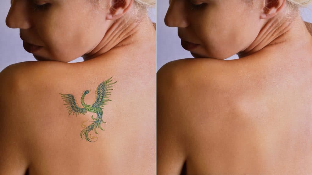 Retirer votre tatouage au laser au maroc